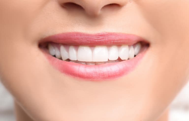 Dental Bonding_image