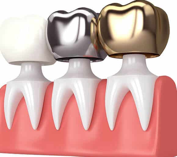 What-Are-Dental-Crowns
