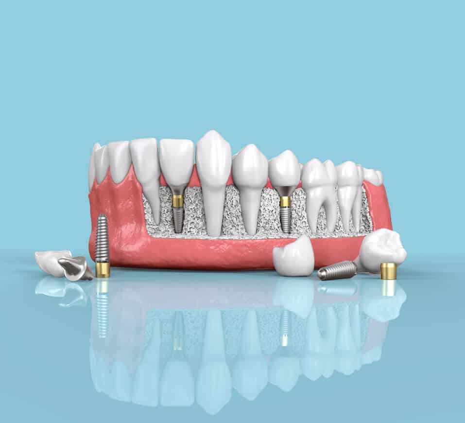 dental-implants_image