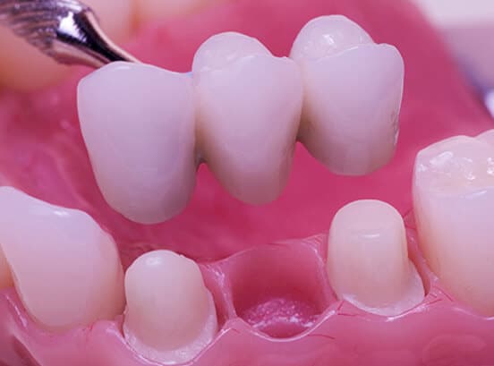 what_is_a_dental_implant_bridge_image